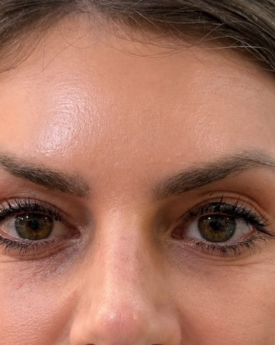 Depois: testa e olhos da mesma paciente.